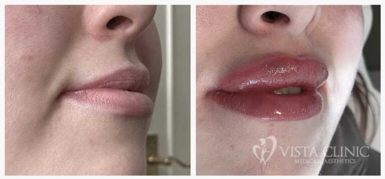 Side views of lips before and after lip filler treatment