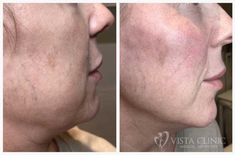 Side profile of a woman before and after jawline and chin filler treatment