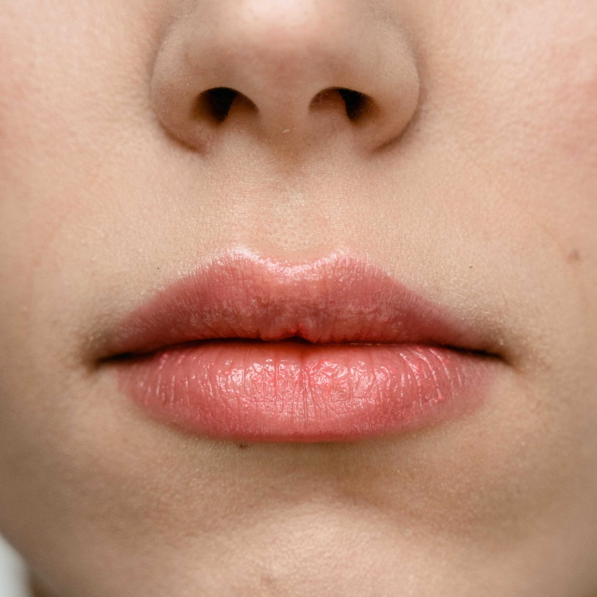 Lip Filler South Dublin, Stillorgan