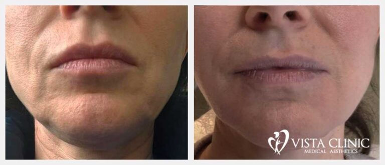 Side by side before and after views of the mouth, chin and jowls following filler treatment