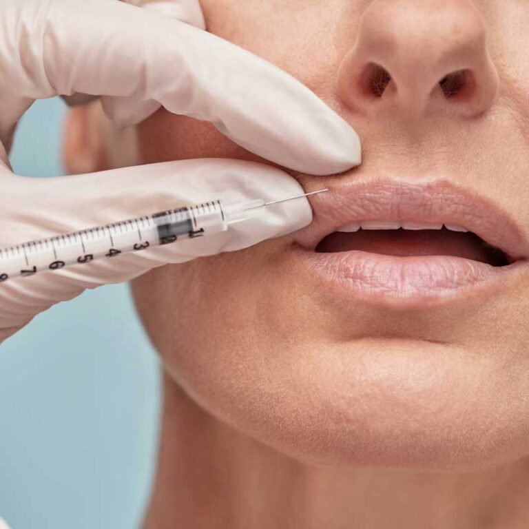 Practitioner injecting dermal filler into lines above the upper lip