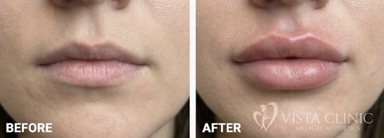 Lip filler before and after at Vista Clinic Dublin