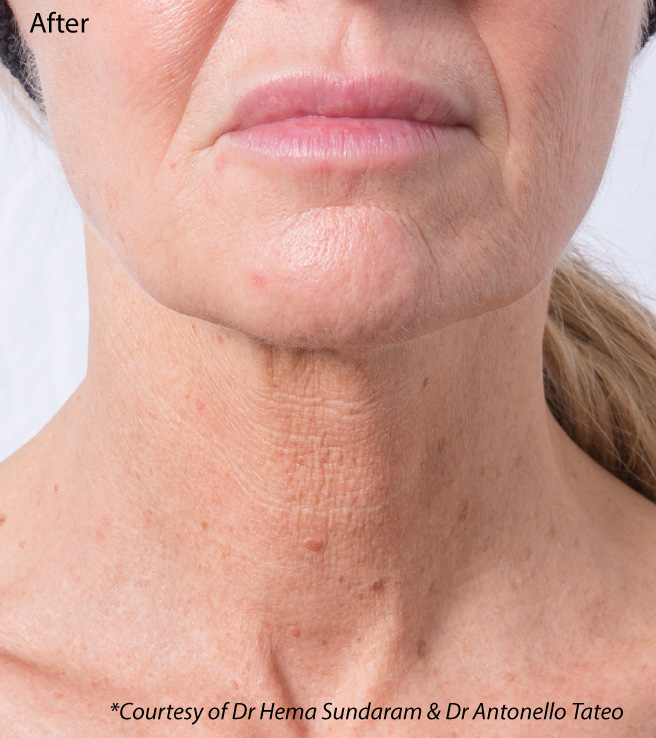 Profhilo neck bio-remodelling, after treatment. Courtesy of Dr Hema Sundaram & Dr Antonello Tateo