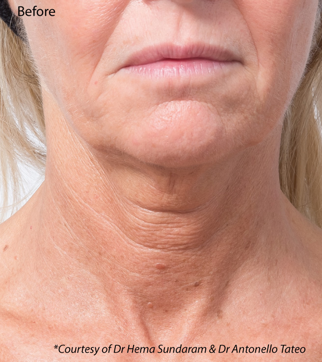 Profhilo neck bio-remodelling, before treatment. Courtesy of Dr Hema Sundaram & Dr Antonello Tateo