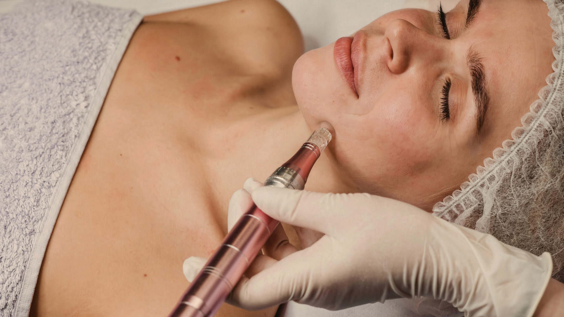 Microneedling treatment at Vista Clinic Dublin